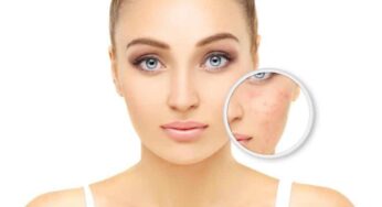 Cilt lekesi problemi neden olur? Doğal maske tarifleri